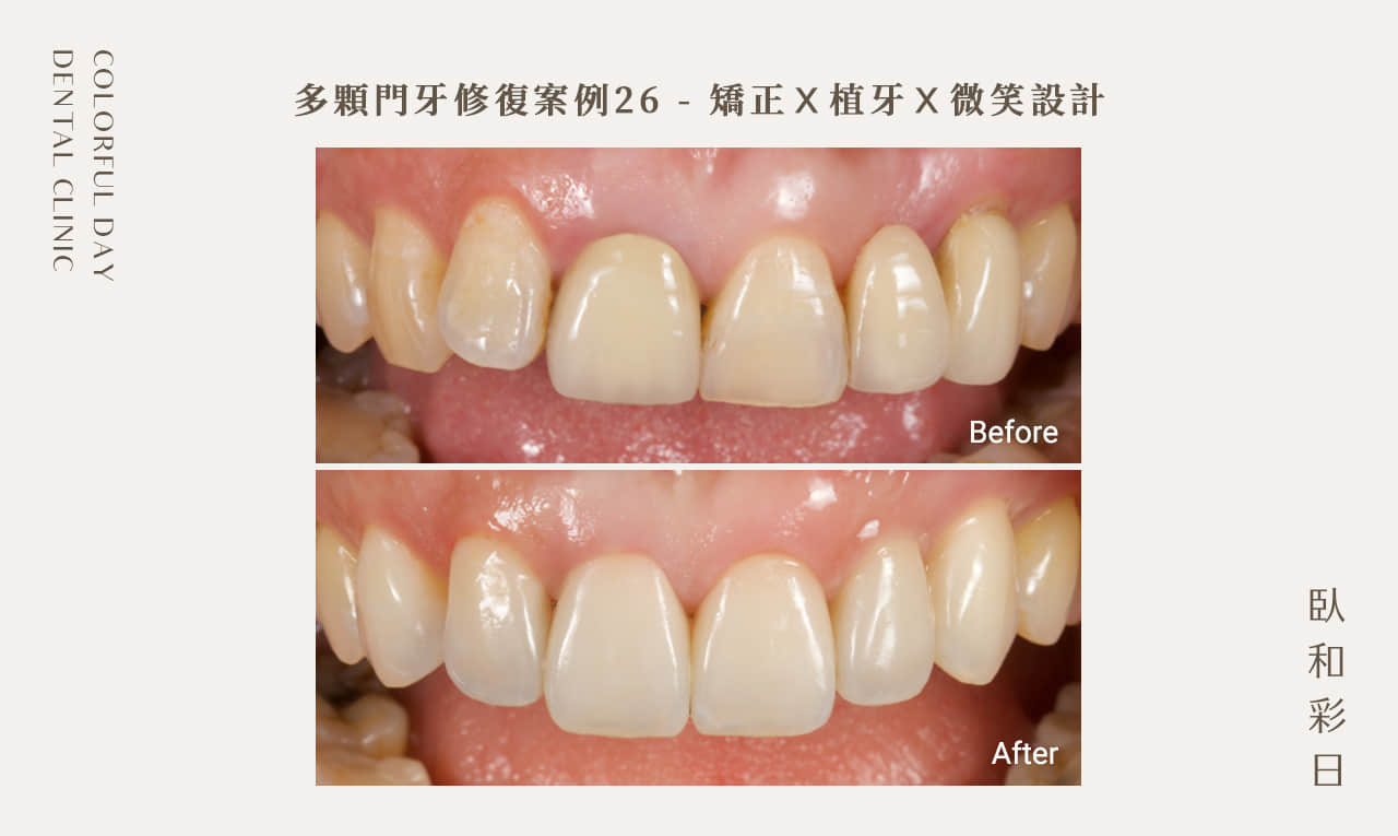 多顆門牙修復案例26 - 矯正Ｘ植牙Ｘ微笑設計
