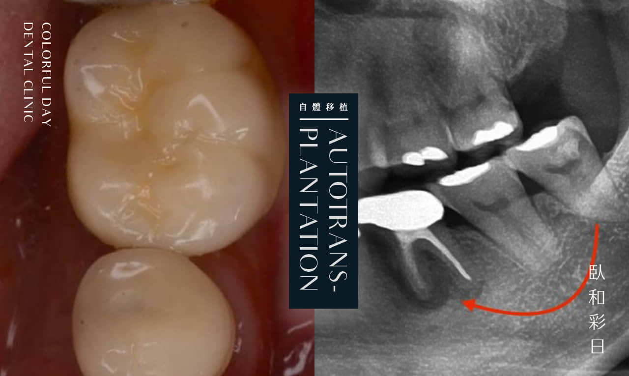 牙齒自體移植術