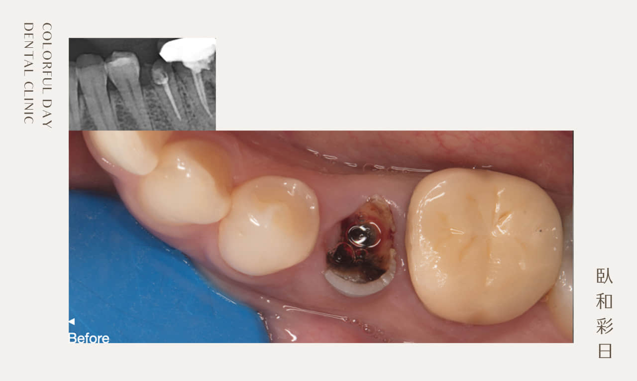 人工植牙案例3 - 常見即拔即種案例