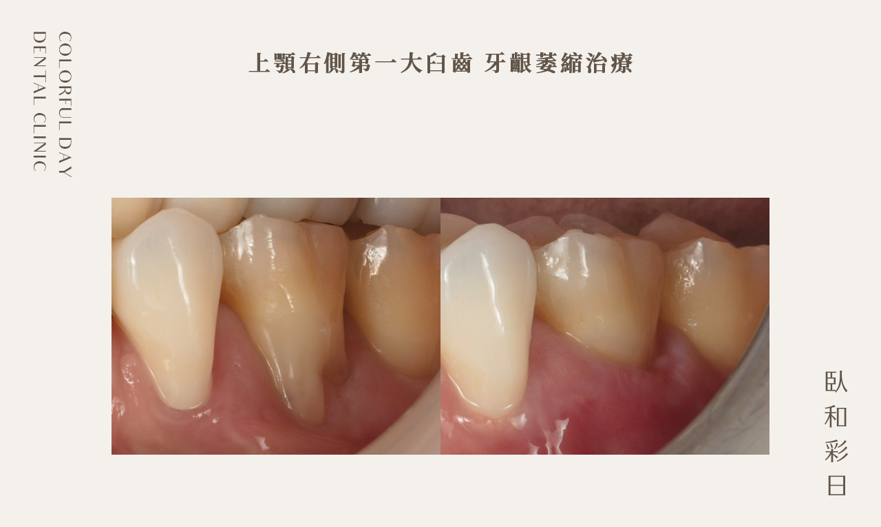 上顎右側第一大臼齒 牙齦萎縮治療